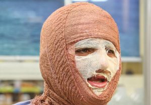 «جان نو» به کمک بیماران سوختگی می‌آید